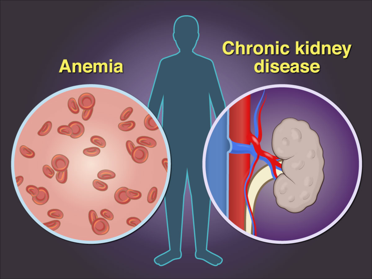 risk-factors-archives-page-2-of-3-american-dialysis-centeramerican
