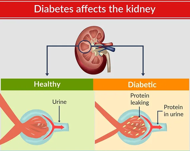 Could You Have Diabetic Kidney Disease? | American Dialysis ...