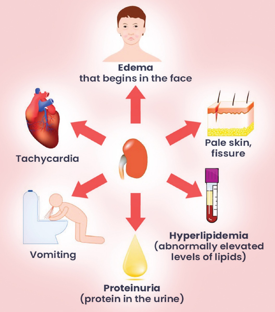 proteinuria-american-dialysis-centeramerican-dialysis-center