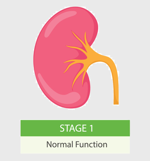 Stage 1 of Chronic Kidney Disease | American Dialysis CenterAmerican ...