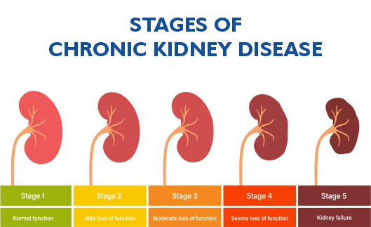 Understanding Chronic Kidney Disease (CKD) | American Dialysis ...