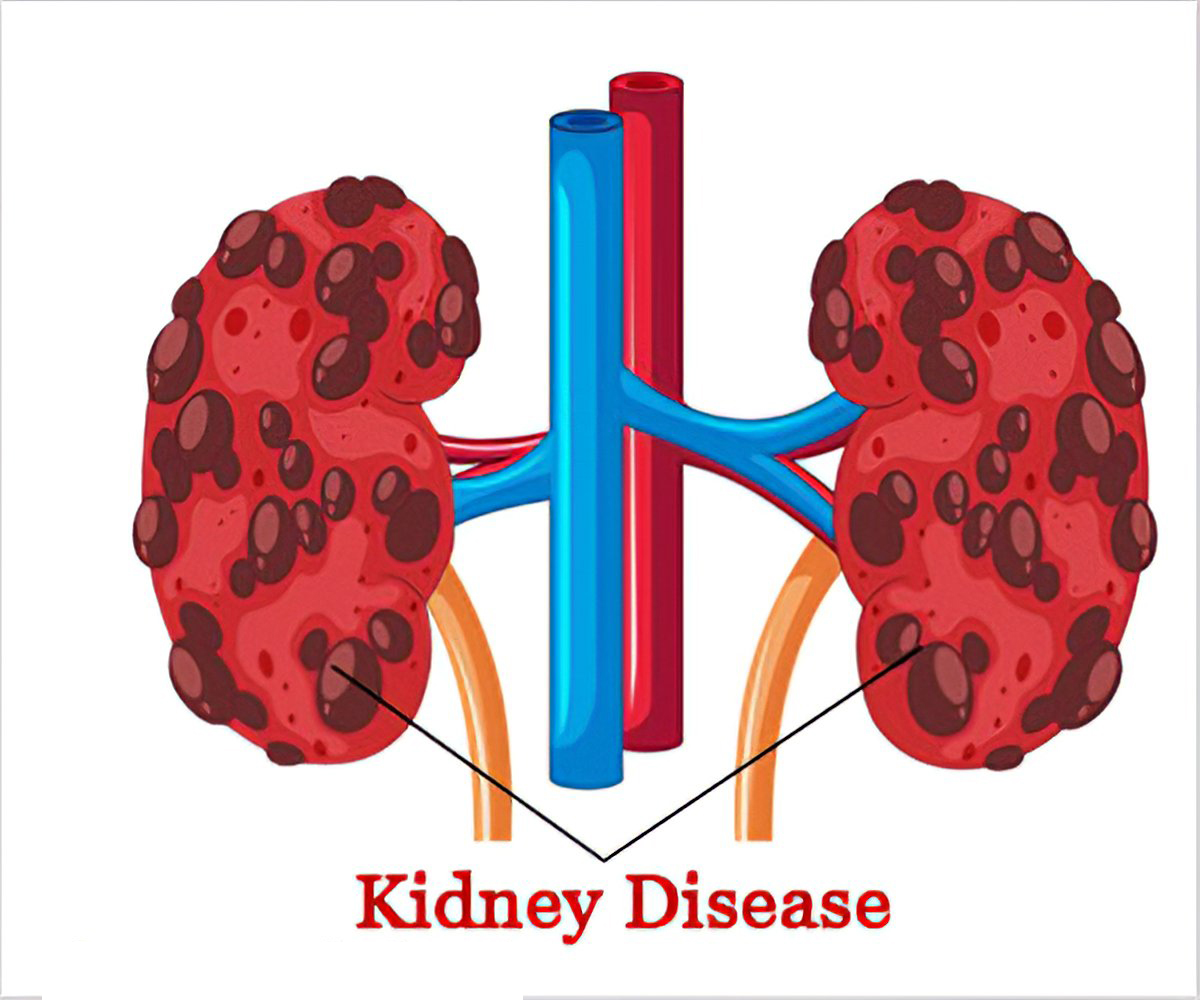 infections-and-chronic-kidney-disease-american-dialysis